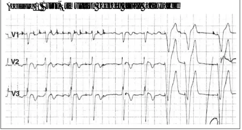 Abbildung 1:  Burst-Stimulation beendet atriale Tachykardie