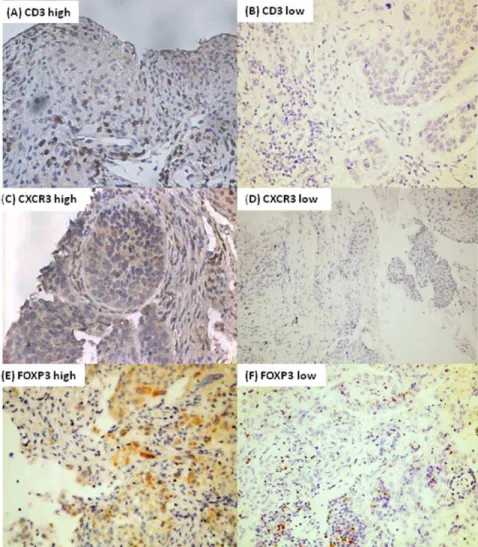 Figure 3. Representative image of immunohistochmical stain demonstrating immunological markers with high and low expression respectively for CD3 (A) (B), CXCR3 (C) (D), and FOXP3 (E) (F) 