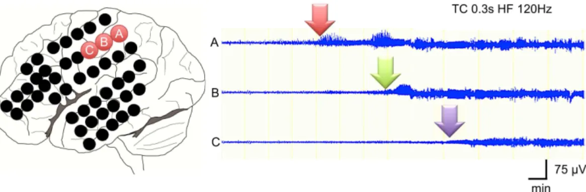 Fig 1. Seizure propagation speed analysis. Three adjacent electrodes 10-mm apart each at the SOZ were used to calculate the seizure propagation speed in cm/min