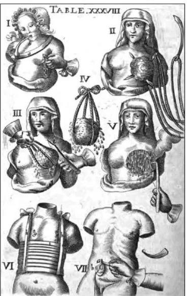 Figura  1:  Mastectomia;  técnica  do  século  XVII.  Table  XXXVIII  in  SCULTET,  Jean  –  L’Arcenal de Chirurgie