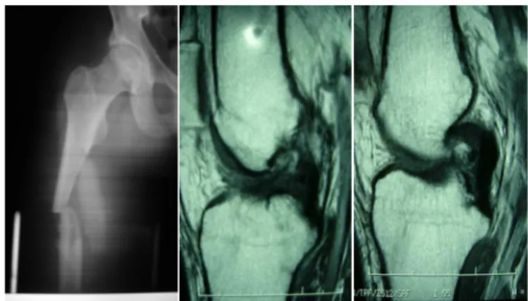 Table 7. Percentage of ACL tears associated to diaphyseal femoral  fractures