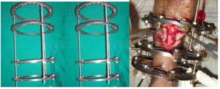 Figure 1     Steel, Carbon Fixator, and Patient with Carbon ring 