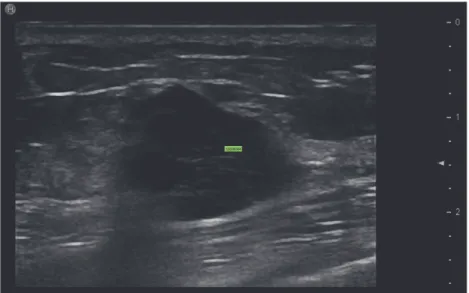 Fig 4. The echo pattern of the breast tumor with TNBC subtype. We observed the marked hypoechoicity in the tumor, and all three markers including ER, PR, and HER2 are negative.