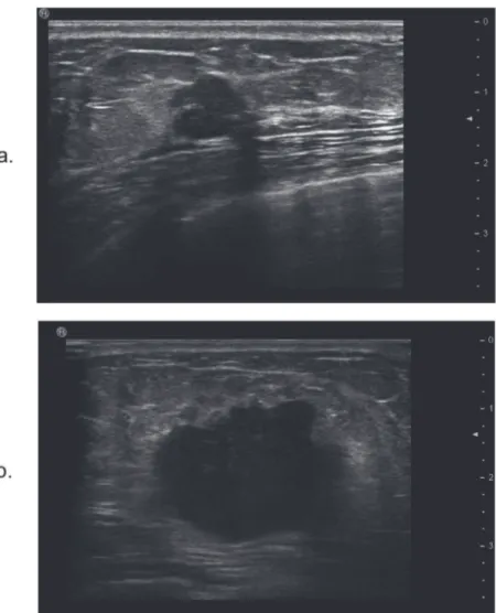 Fig 1. The maximum diameter of the tumor and lateral acoustic shadow feature on ultrasound