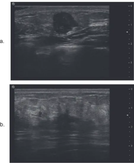 Fig 2. The tumor margin on ultrasound. a. It shows that there is a slight lobulated margin of normal-like breast tumor