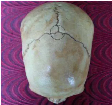Table  1:   Show ing  t he  occur rence  of  sut ural  bones  in dif ferent  point s bet w een m ale and f em ale skull.