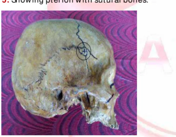 Fig. 5:  Show ing pt er ion w it h sut ural bones.