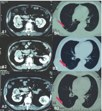 Figure 2. Imaging data of No. 17 patient who had bilateral RCC with lung metastasis. (A1) Before neoadjuvant therapy, maximum tumor diameter in right kidney was 7 cm, maximum tumor diameter in left kidney was 4 cm