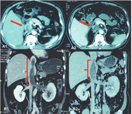 Figure 6. Imaging data of No. 16 patient with obstructed inferior vena cava (ICV). (A1) IVC tumor thrombus filled IVC before neo-adjuvant therapy