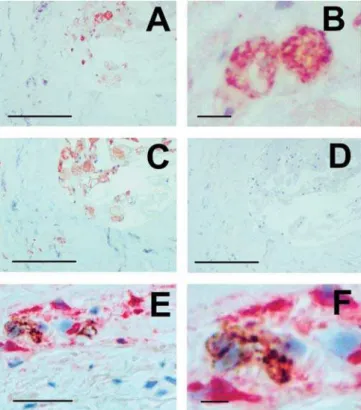 Figure 8. Identification of HIV-1–Positive Macrophages in Atherosclerotic Plaques of HIV-Infected Subjects.