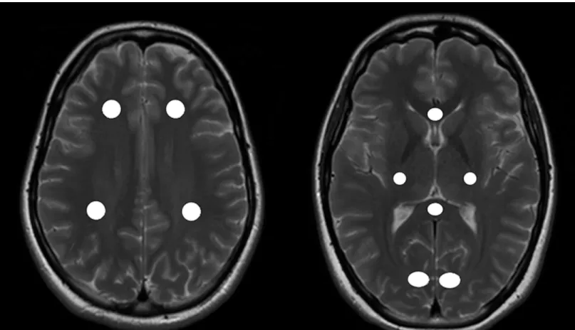 Fig 1. ROI localization in the NAWM. Figure showing regions of interest (ROI) placement on an exemplary T2w image of a healthy control (HC)