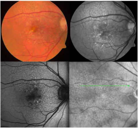 Figure 1. Imaging Characteristics of Reticular Pseudodrusen. Reticular pseudodrusen appear as faint, yellowish, interlacing networks along the arcades on color fundus images (top left) and as light interlacing networks on red-free imaging (top right)