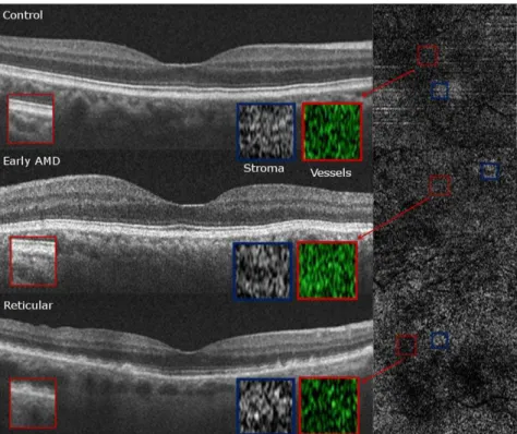Figure 5. Qualitative Choriocapillaris Assessment Comparing C-Scans and B-Scans (Example 1)