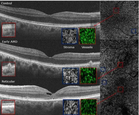 Figure 6. Qualitative Choriocapillaris Assessment Comparing C-Scans and B-Scans (Example 2)