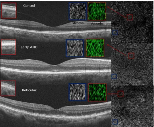 Figure 7. Qualitative Choriocapillaris Assessment Comparing C-Scans and B-Scans (Example 3)
