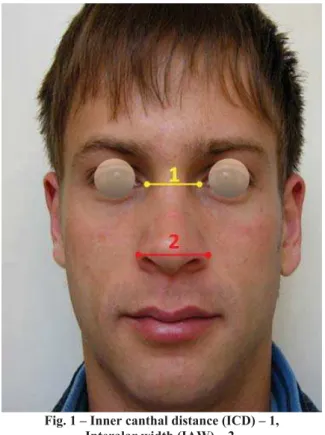 Fig. 1 – Inner canthal distance (ICD) – 1, Interalar width (IAW) – 2.