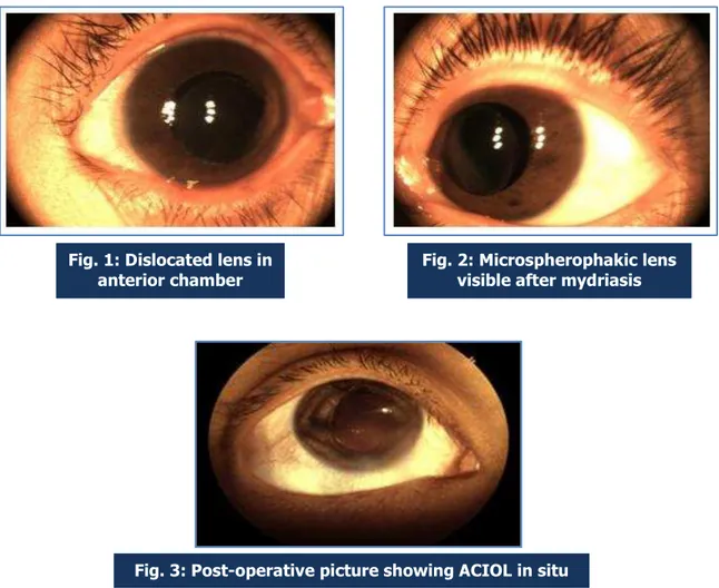 Fig. 1: Dislocated lens in  anterior chamber 