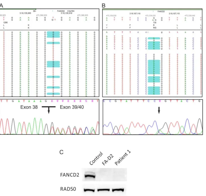 Figure 2. Genotyping of patient 1. (A) The heterozygous FANCD2 splice site mutation c.3888+2T.G in patient 1