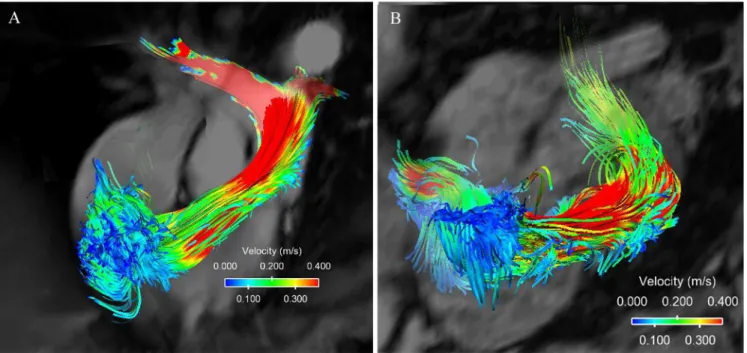 Fig 1. 4D flow patterns. (A) Flow pattern of a healthy subject in the right ventricle and the pulmolnary artery