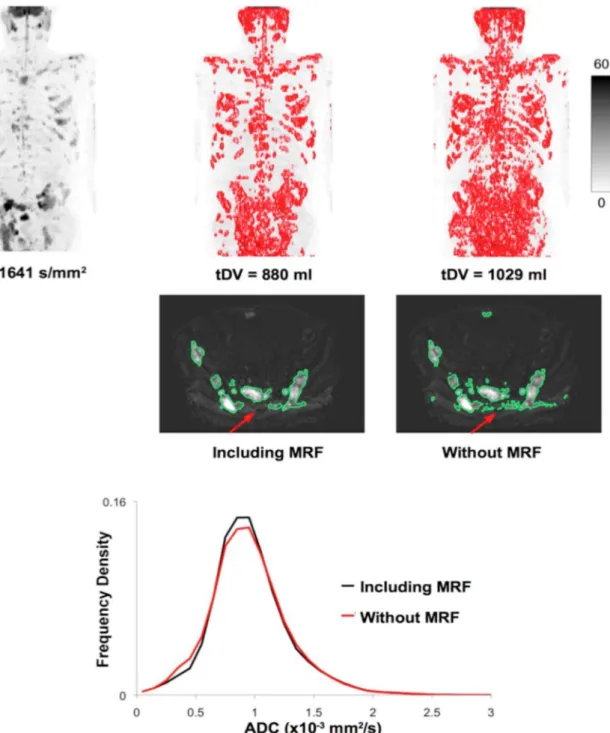 Figure 3. Comparison of segmentation results, achieved by simple thresholding and with the inclusion of a Markov random field (MRF) model, for a WBDWI data set of a patient diagnosed with multiple myeloma