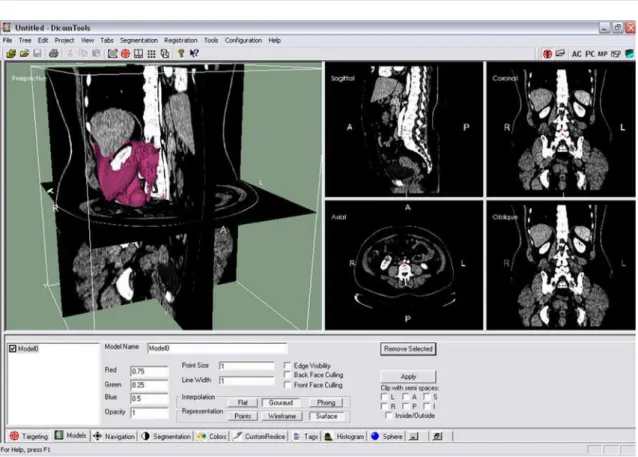 Figure 1. The region of interest has been used to generate the 3D reconstructed surface, displayed  in the thoraco-abdominal CT scan