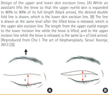Fig. 1. Design of the excision lines