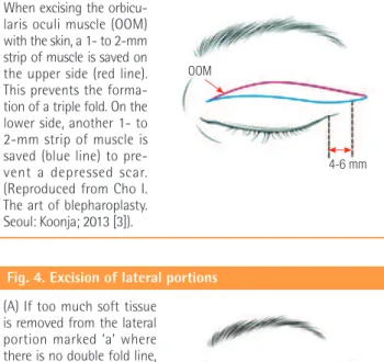 Fig. 5. The fixation points in relation to the incision