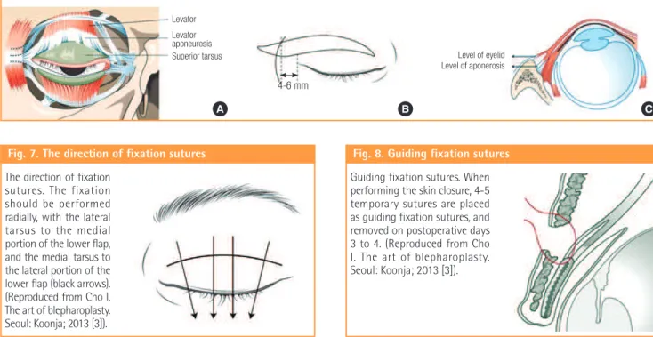 Fig. 8. Guiding fixation sutures Guiding fixation sutures. When  performing the skin closure, 4-5  tempo rary sutures are placed  as guiding fixation sutu res, and  removed on post operative days  3 to 4