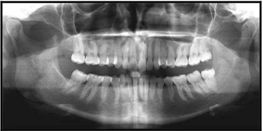 Figura 11  –  Estrutura  anatômica dos maxilares –  visão radiográfica panorâmica  (Arquivos da disciplina de Radiologia Odontológica, UFSC)