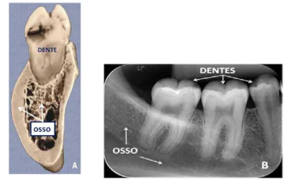 Figura 13 – Estrutura dental e óssea: (A) imagem clínica; (B) imagem radiográfica  (Arquivos da disciplina de Radiologia Odontológica da UFSC)