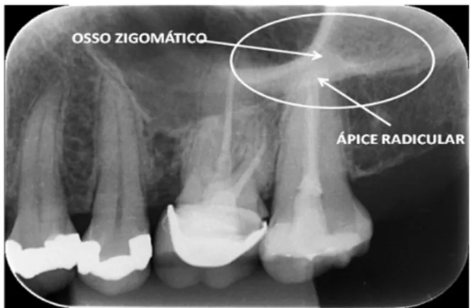 Figura 14  –  Radiografia de molares superiores, com  osso zigomático projetado  sobre os ápices do dente 27, junto ao seio maxilar  (Arquivos da disciplina de  Radiologia Odontológica, UFSC)