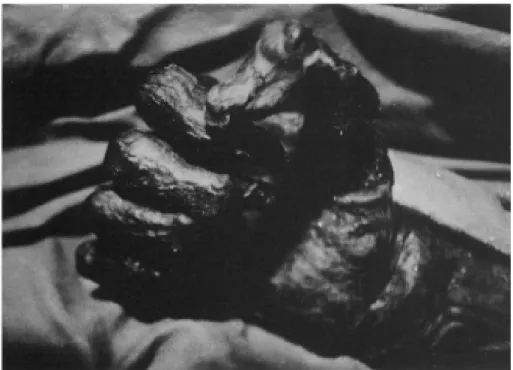Figure  1.  Detail  of  the  right  hand  of  the  Val  Senales  mummy  (Tyrol). 