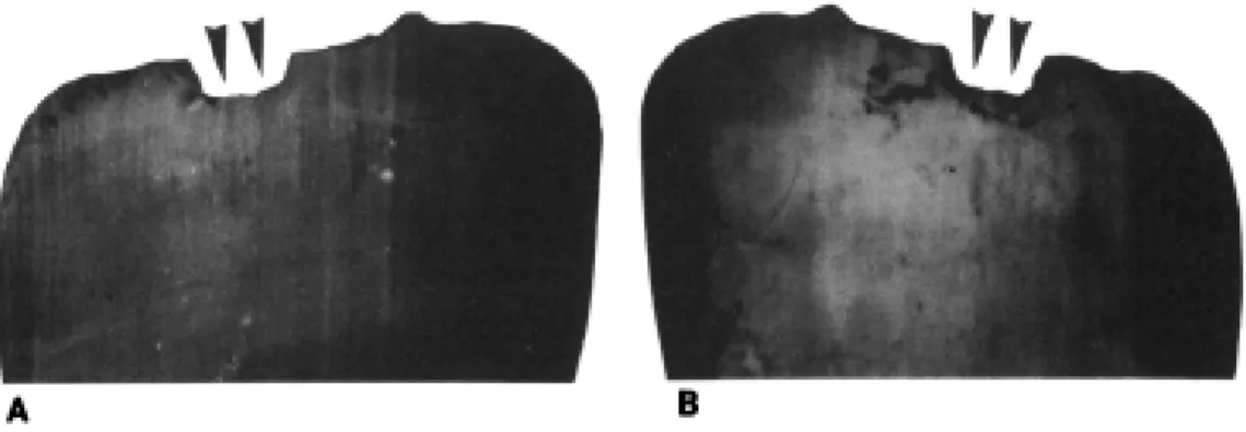 Figure  7.  Tip  of  the  nail.  A:  ventral  side.  B:  dorsal  side.  Dark  amorphous  encrustations  are  clearly evident  on  the ventral  side,  where they are  tightly  bonded  to the  onycokeratin,  especially  on  the  beds  of  the  furrows  of  t