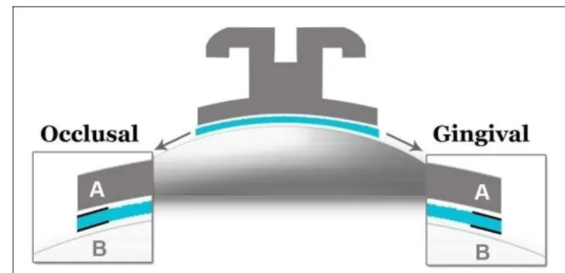 Figure 1. Schematic picture for scoring criteria. Four evaluated interfaces are shown, at occlusal and  gingival margins, and bracket-adhesive and adhesive-enamel interfaces 