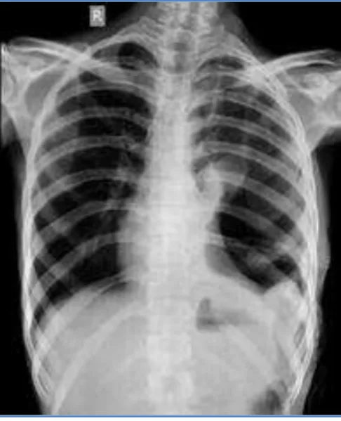 Fig. 1: Chest radiograph showing a left sided hydrop- hydrop-neumothorax with intercostal drainage tube insitu