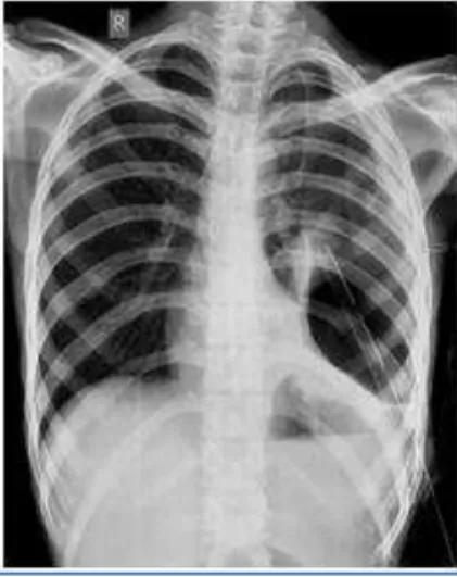 Fig. 2: Chest radiograph taken three days after intercostal drainage  tube insertion showing persistent left hydropneumothorax 