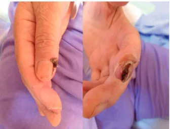 Figure 1. Necrotic lesion on the tip of left index inger and  right thumb
