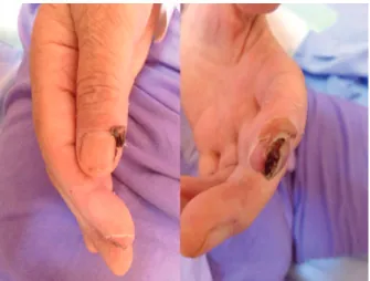 Figure 1. Necrotic lesion on the tip of left index inger and  right thumb