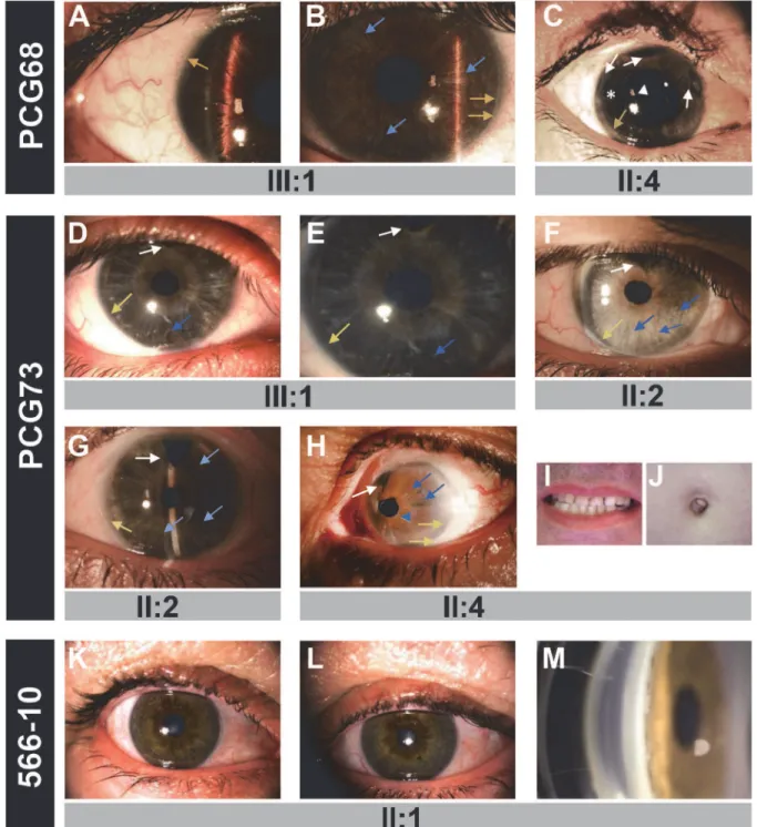 Fig 2. The phenotypes associated with the FOXC1 mutations identified in this study. (A) Right and (B) left eye of subject PCG68 III:1