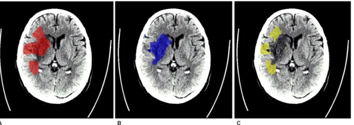 Fig 1. Example of a misclassified ischemic core. A. Ischemic core as selected by CT perfusion software on baseline CTP (projected on follow-up noncontrast CT)
