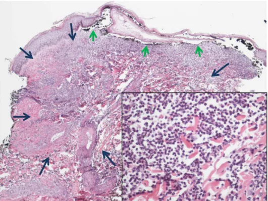 Fig. 5. Low power of right anterior proximal thigh skin biopsy showing changes of pyoderma gangrenosum