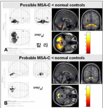 Figure 4. Comparison of cerebellar metabolism between possible  and probable cerebellar type multiple system atrophy (MSA-C) by 
