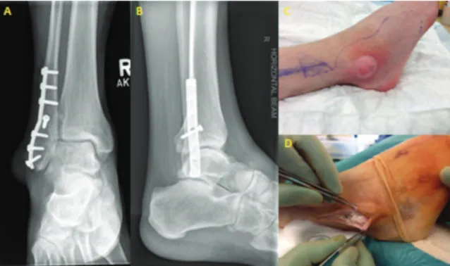 Fig. 1: (A) Tophaceous gout simulating infected ankle metalwork. (B) AP and lateral radiograph of the patient’s ankle revealing intact metalwork and no signs of osteomyelitis