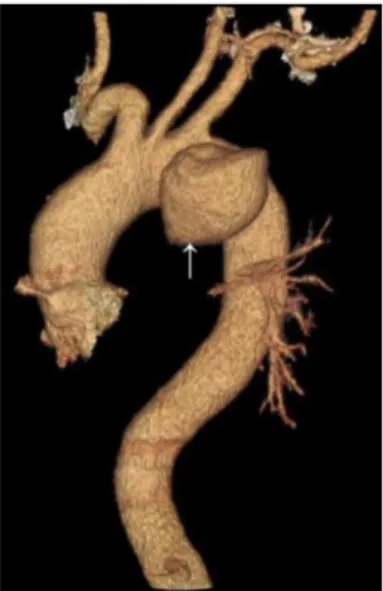 Figure 2. CT angiography of aorta. White arrow pointing to  pseudoaneurysm of aorta distal to subclavian origin.