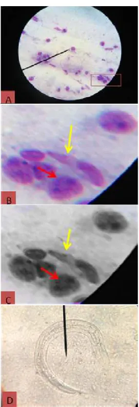Figure 3: Histopathological examination of liver section  showing a focal area of necrosis red arrow which  surrounded by a zone of inflammatory cells black arrow, H 