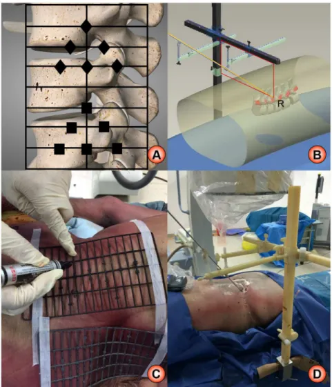 Fig 1. The schematic diagram of HELLO system. A: location theory of surface locator; B: location theory of puncture locator; C: real practice of surface locator; D: real practice of puncture locator.