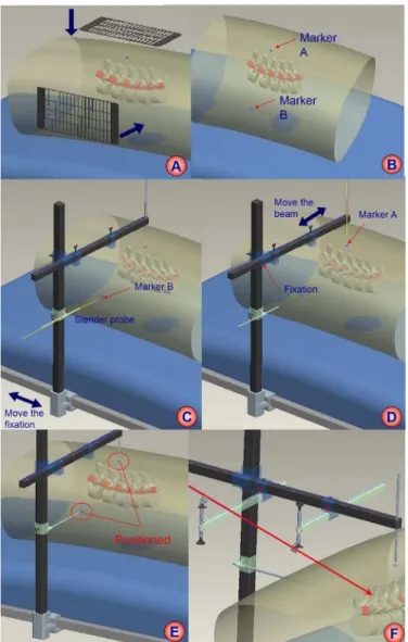 Fig 2. The schematic procedure of HELLO system. A: the attachment of surface locator; B: skin marker of puncture target; C: positioning of puncture locator to the lateral marker; D: positioning of puncture locator to the back marker; E: positioned conditio