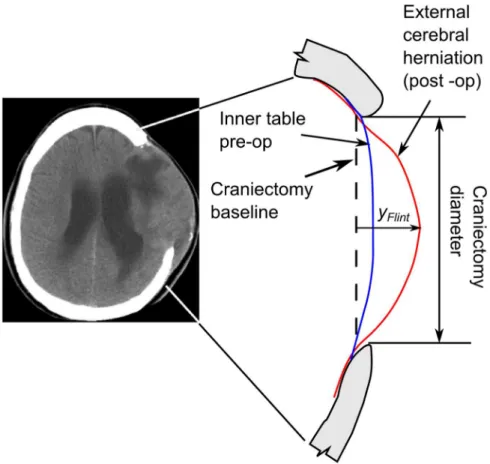Figure 1. Geometry changes in the brain due to decompressive craniectomy.