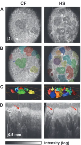Fig 4. Wide-field OCT imaging of LSGs in a patient with CF (No. 11) and in a HS (No. 30)
