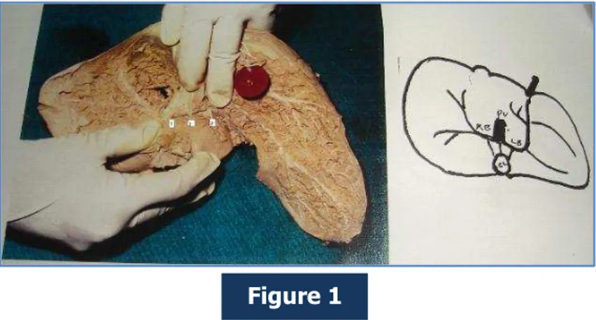 Figure  1:  Portal branches to Caudate Lobe. 1. From right branch of Portal vein, 2. From Portal  trunk 3